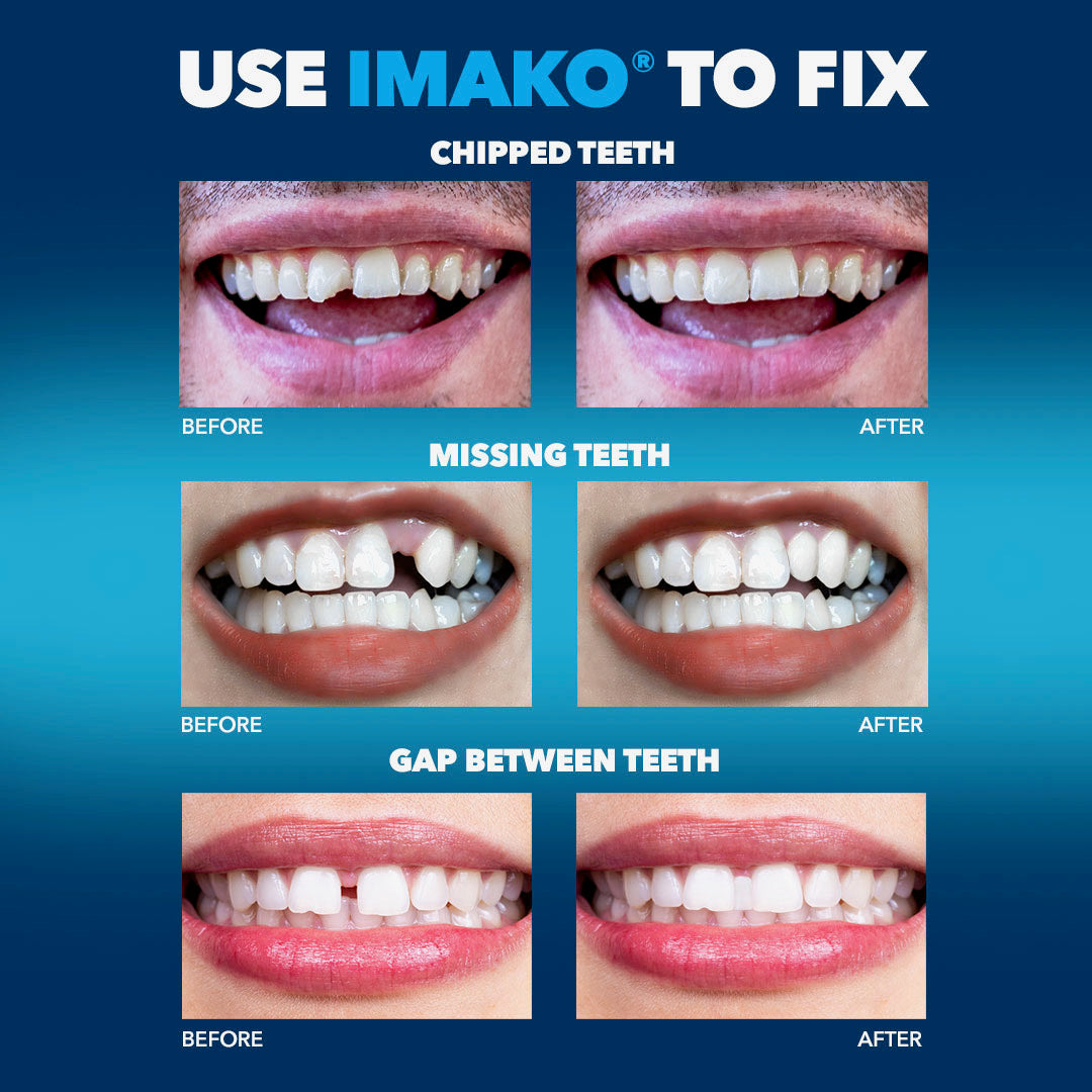 Imako® Tooth Tinted Plastic – Temporary Tooth – For Chipped Tooth & Fill Gaps in Teeth