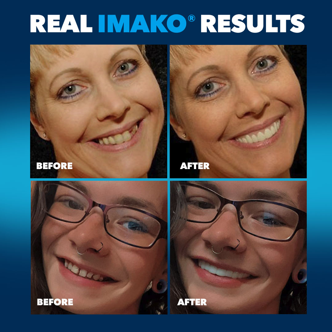 Imako® Cosmetic Teeth – Refill Kit